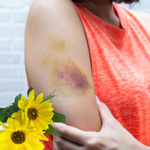 This image shows a person's arm with a visible bruise, characterized by a mix of yellow and purple coloration. The individual is wearing a bright orange sleeveless shirt and is gently holding their bruised arm. In the lower left corner of the image, there is an overlay of Arnica flowers, suggesting the potential use of Arnica for treating bruises.