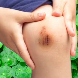  Close-up of a person holding a healing wound on their knee with gotu kola leaves in the background.